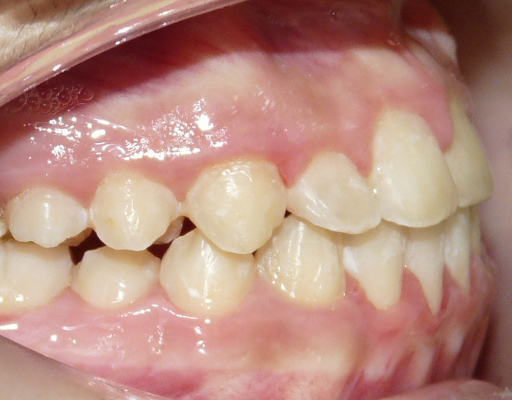 Ortopedia dentofacial después caso 6